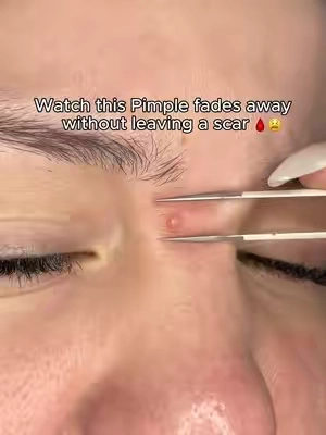 Watch this Pimple fades away without leaving a scar@Dr.Leo-USA #weeklydealsn #summerwins #acne #acneskin #GlowUp