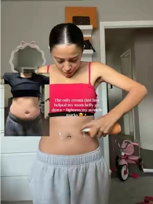 #fypシ゚viral #momtok #stretchmarks #foryoupage 