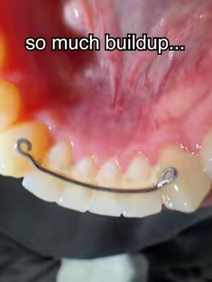 The buildup had to go 😭 #gaptaincrunch #fyp #teethwhitening #viral #TikTokShopCreatorPicks 