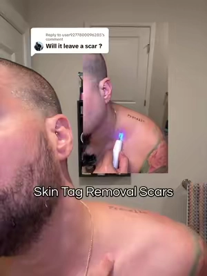 Replying to @user9277800096285 Small scars after skin tag removal are normal. They are small and barely noticeable! #skintag #skintags #skintagremoval #beautypen 