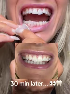 The ultimate white teeth duo #teethwhitening #teethwhiteningstrips #whiteteeth #teethcare @Lumineux 
