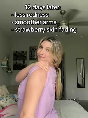 after years i finally found something working to clear my KP 🥲 #KP #strawberryskin #skintransformation #keratosispilaris 