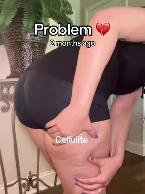 Bye bye cellulite …My legs look way smoother now! #c#cellulitem#massagetiktokshopcreatorpicks #smootherskin #legs @Tiktokshopfinds 