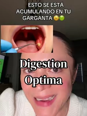 Tonsil stones, cálculos amigdalinos or tonsilolitos, mala digestion, digestion, Enzimas digestivas, Enzimas, probiotics, probioticos, mal aliento, flatulencia, inflamacion, estreñimiento #enzimas #enzimasdigestivas #malaliento #tonsilstones #tiktokshopbacktoschoolsale disclaimer: precios promociones y resultados pueden variar 
