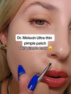 WHERE is the pimple patch!? These new Dr melaxin ultra thin pimple patches are a life saver for adult acne #sohochic #tiktokshopcreatorpicks #tiktokshopsummersale #TikTokshopbacktoschool #acne 