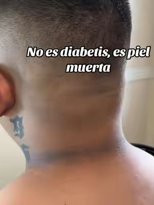 NO  ES DIABETIS, ES PIEL MUERTA Y CON ESTE PRODUCTO TE QUITA TODO Y TE ACLARA, LO PUEDES USAR EN TODO TU CUERPO Y NO TE QUEMA ##drmelaxin##drmelaxinpeelshot##deadskin##SKINCARE##fyp@@Dr.Melaxin