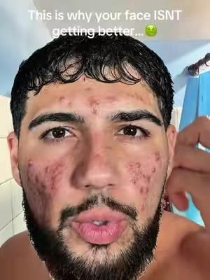 Stop blaming your genetics, i use to do that before too. Just clean your face correctly!💪🏼
