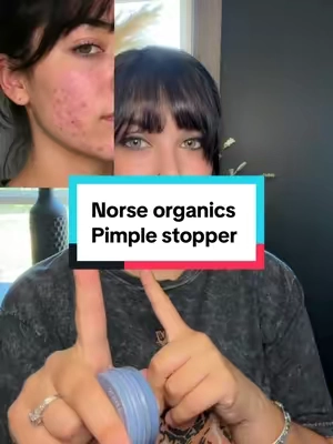 #norseorganics #pimplestopper #acnetreatment #acneproneskin #teenageacne 