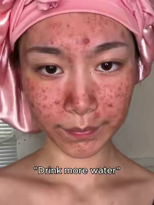 Acne girls use this@Dr.Leo-USA #acne #acneskin #acneproneskin #weeklydeals #summerwins 