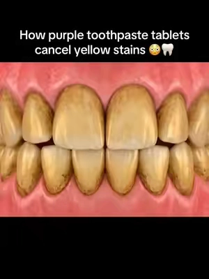 The results are actually insane… 😳🦷‼️ #yellowteeth #whiteningtoothpaste #teethwhitening #hydroxyapatitetoothpaste #oralcare 