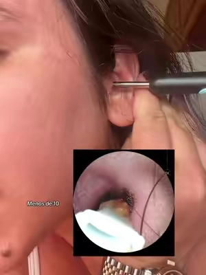 Limpia oídos con cámara #earwaxremoval #ad 