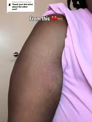 Replying to @LiaFinds yes I did do both arms here's the right arm #stretchmarks #expressions 