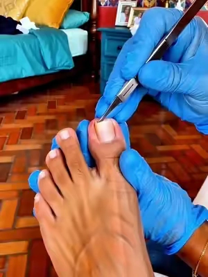 Esta es la forma correcta de tratar las uñas encarnadas. #fyp#tiktokshopmemorialday#DealsForYouDays#TikTokshopbacktoschool#SohoChic