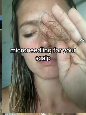 Replying to @HaleyMeansBusiness korean microneedling for your scalp! This has helped me so much . . . . . Comment hair for the link if interested! #ad