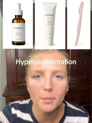 Replying to @anxiety_salad when it looks like you have dirt all over your face try tranexamic acid 🔥🔥 . . . . Comment TX if interested (ad)