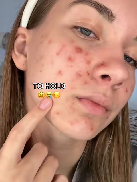 Not sponsored, just wanted to share what actually helped clear up my acne. It‘s been a journey! #acnetreatment #tiktokshopstockup #CityTasteTest #skincareroutine #glowingskin 
